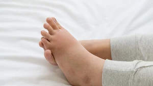 W akromegalii można zaobserwować zwiększenie masy ciała, powiększenie rąk, stóp, żuchwy, ust, nosa, a nawet języka