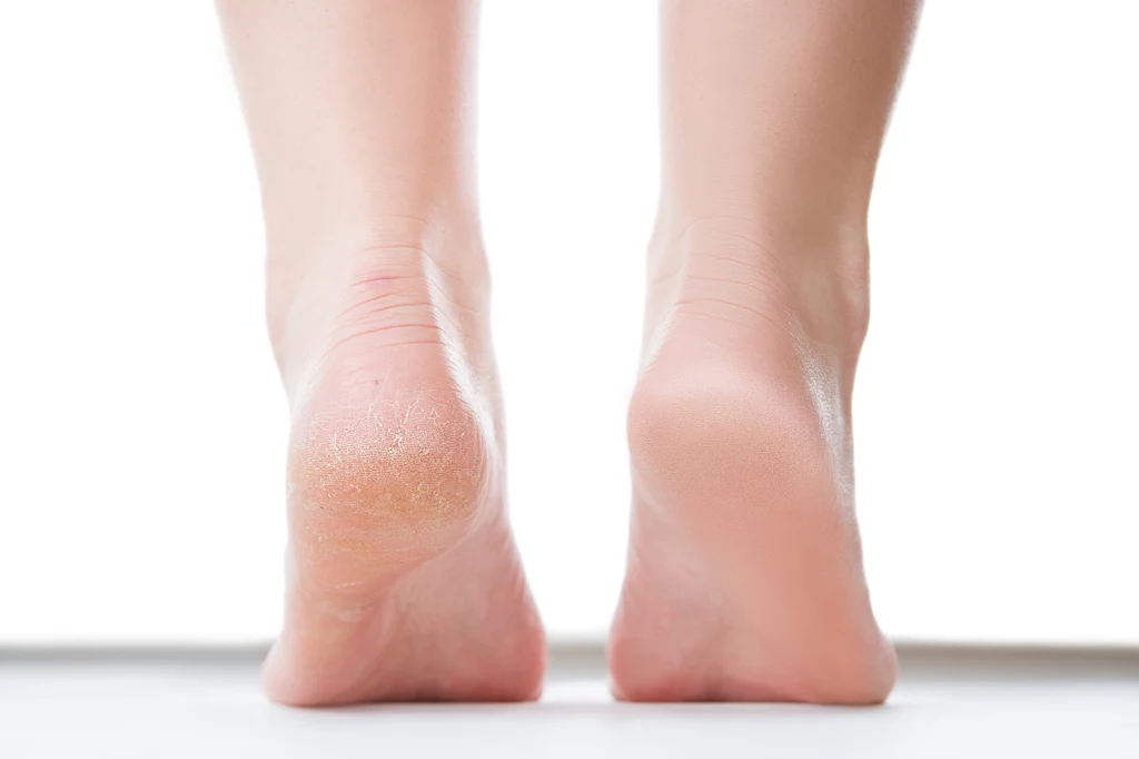 Skóra na stopach jest sucha i pęka na piętach? Oto jak pozbyć się problemu