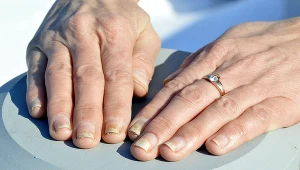 Onycholiza paznokci objawia się płytką odklejającą się od skóry, rosnącą jakby ku górze