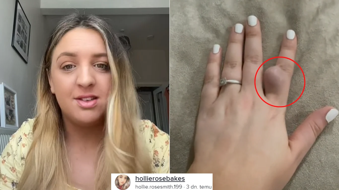 Hollie nie spodziewała się, że jej post osiągnie tak duży zasięg. Postanowiła podzielić się historią leczenia „ciążowego palca” Hollie nie spodziewała się, że jej post osiągnie tak duży zasięg. Postanowiła podzielić się historią leczenia „ciążowego palca”