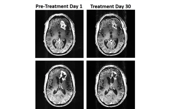 Skany pokazują redukcję rozmiarów guza po zastosowanej terapii