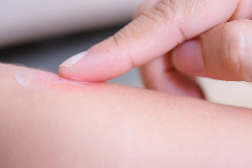 Na miejsce po ugryzieniu można zastosować maść ze sterydem lub okład z sody oczyszczonej