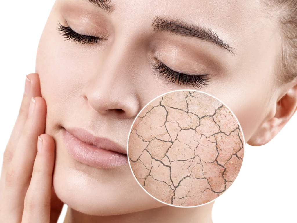 Uszkodzenia i zaburzenia w funkcjonowaniu bariery lipidowej są przyczyną suchości skóry