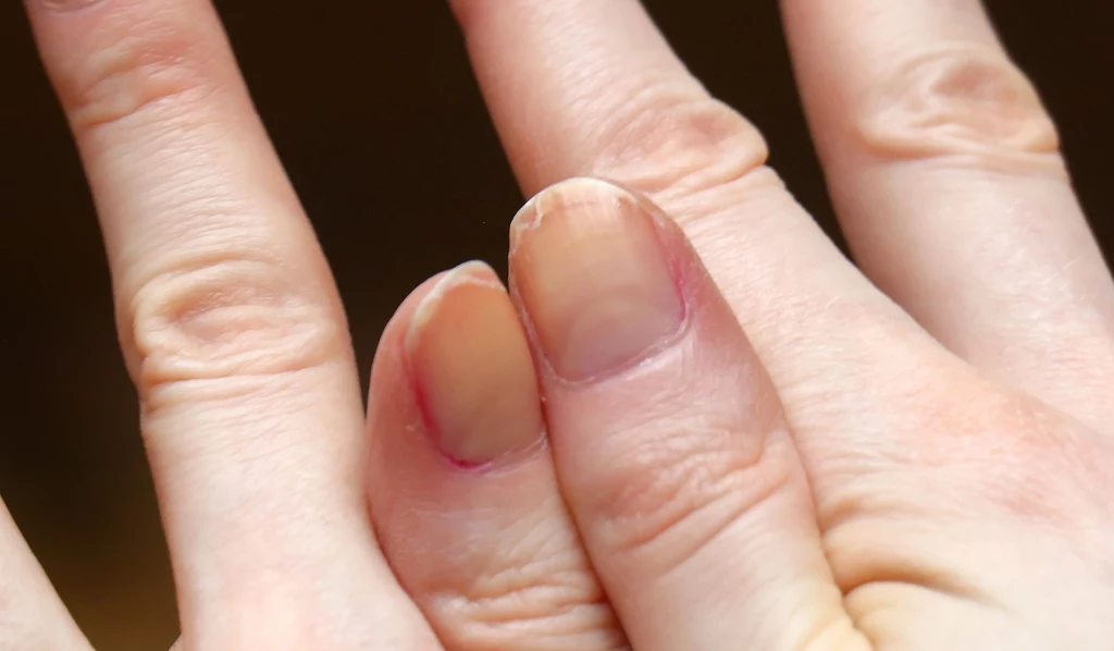 Poznaj proste sposoby na rozdwajające się paznokcie