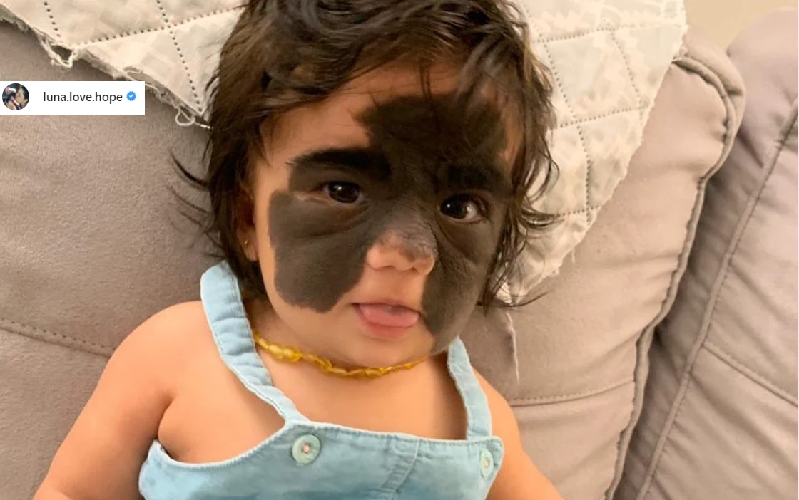 Gdy maleńka Luna przyszła na świat jej rodzice byli bardzo zaniepokojeni. Obawiali się, że zmiana, która pokrywała twarz dziecka, jest złośliwa Gdy maleńka Luna przyszła na świat jej rodzice byli bardzo zaniepokojeni. Obawiali się, że zmiana, która pokrywała twarz dziecka, jest złośliwa