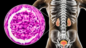 Zmian ilości, zabarwienia i częstotliwości oddawania moczu nie należy ignorować
