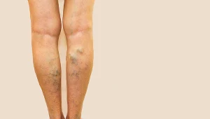 Nieleczone żylaki mogą prowadzić do zakrzepicy i zapalenia żył