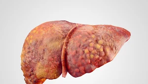 Marskość wątroby to nie tylko choroba alkoholików, zachorować mogą m.in. cukrzycy i leczący się przewlekle