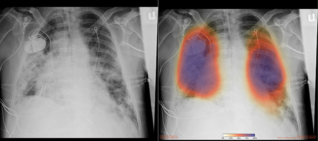 Specjaliści próbują wykorzystywać gromadzone na różne sposoby dane do uczenia modeli wykrywających najważniejsze symptomy wirusa, wspierających stawianie diagnoz, prognozujących, jak wirus będzie się rozwijał