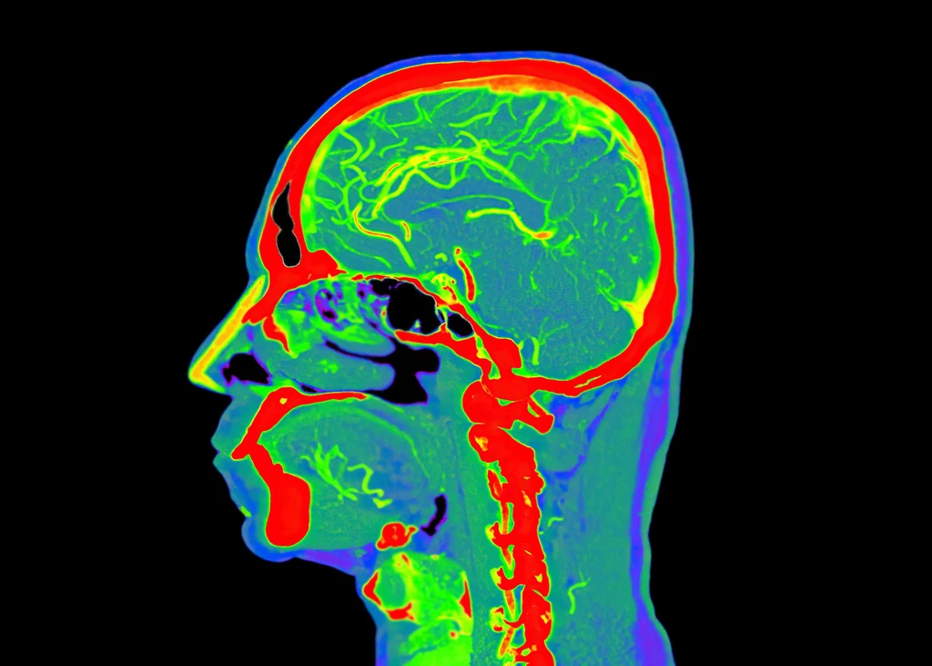 Nowo odkryta odmiana choroby Alzheimera atakuje osoby po 40. roku życia