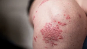 Każdy powinien wiedzieć jedno - łuszczycą nie można się zarazić