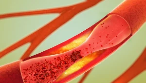 U niektórych pacjentów choroba daje o sobie znać już w dzieciństwie