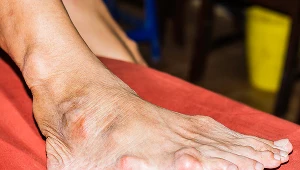 Ból stawów? To może być dna moczanowa