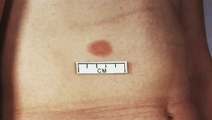 Zaczyna się od tzw. blaszki macierzystej, po krótkim czasie pojawiają się kolejne, mniejsze