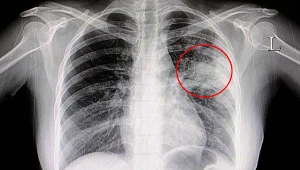 Zapalenie płuc. Śmiertelnie groźna choroba