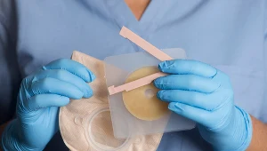 Jak się żyje z wyłonioną stomią? Co to właściwie oznacza?