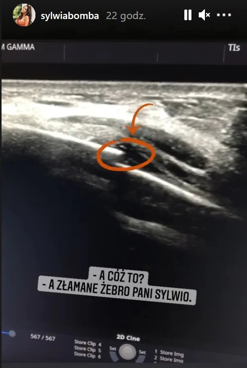 Sylwia Bomba poinformowała o złamaniu żebra