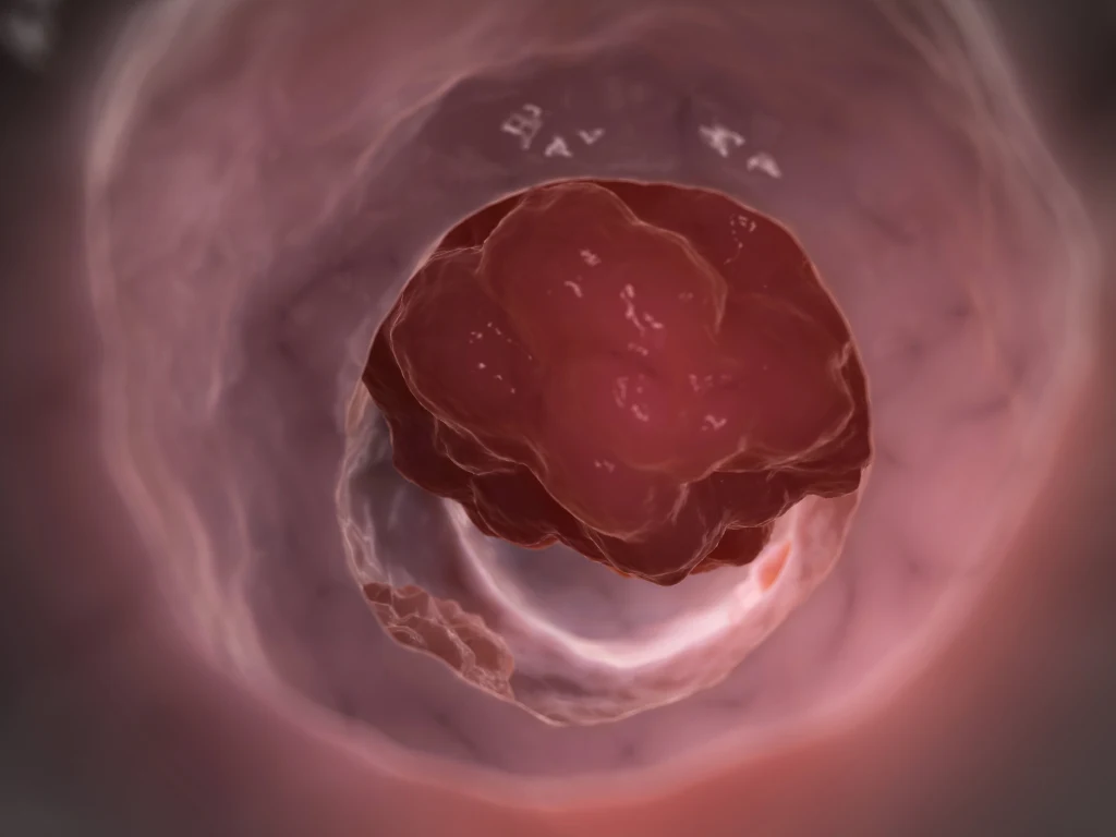 Im mniej mięsa w diecie, tym lepiej. Wegetarianie i weganie rzadziej chorują na raka jelita grubego