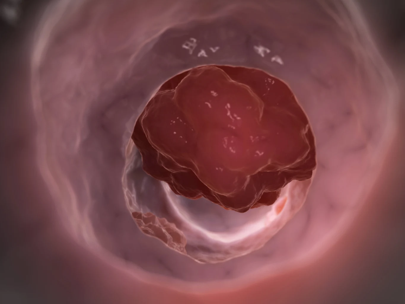 Im mniej mięsa w diecie, tym lepiej. Wegetarianie i weganie rzadziej chorują na raka jelita grubego