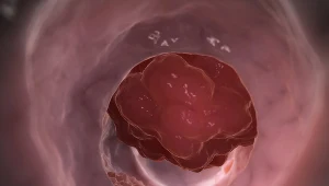 Im mniej mięsa w diecie, tym lepiej. Wegetarianie i weganie rzadziej chorują na raka jelit grubego