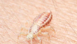 Wszy mogą "przeskoczyć" na każdego, nie należy więc ich łączyć z zaniedbaniem i brakiem higieny