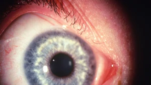 Plamki Brushfielda nie mają żadnego wpływu na działanie analizatora wzrokowego