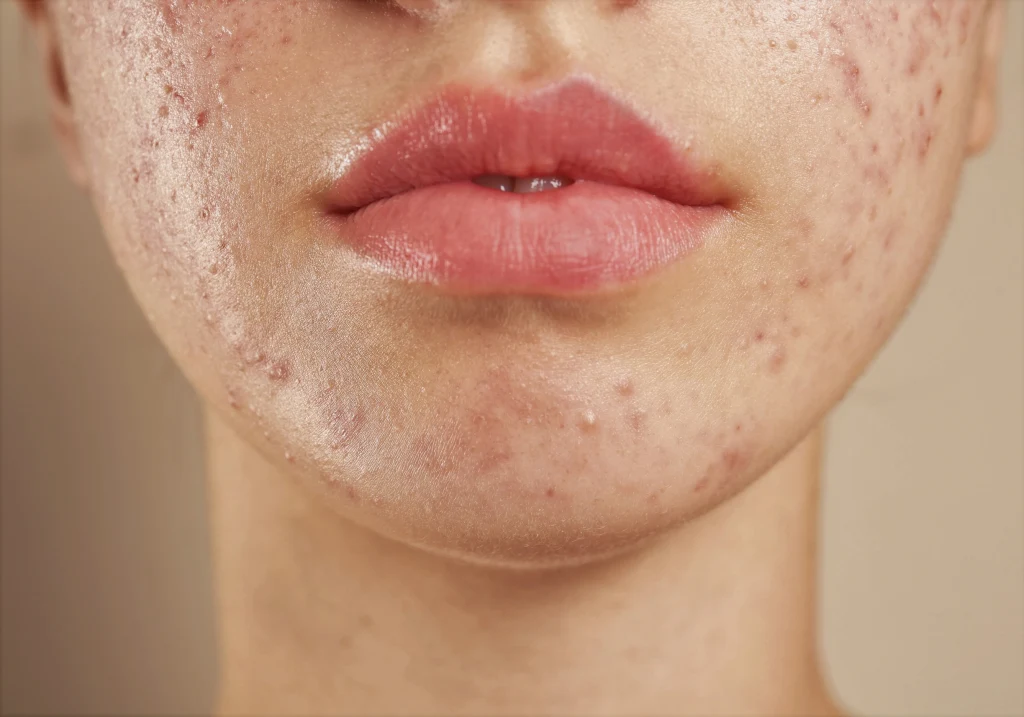 Trądzikowi sprzyjają także tłuszcze trans i ostre przyprawy 