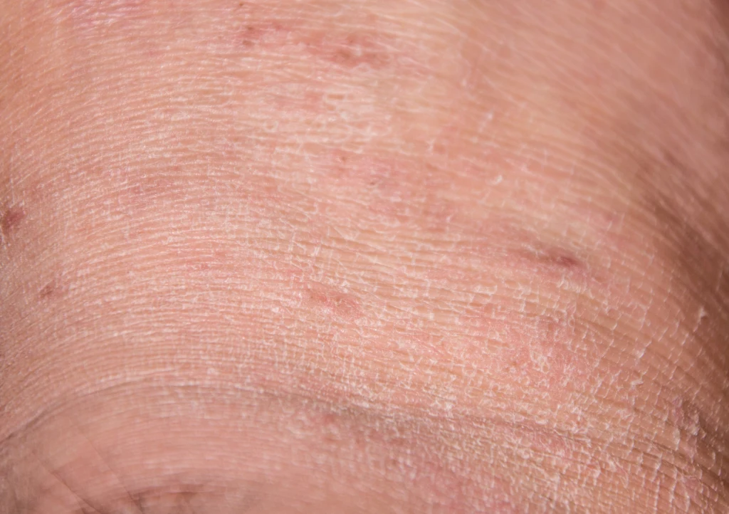 Sucha skóra, "inna" w dotyku, z pojawiającymi się "pajączkami"? To może być sygnał od wątroby