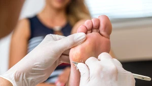 Leczenie brodawczaka opiera się przede wszystkim na usunięciu zmiany