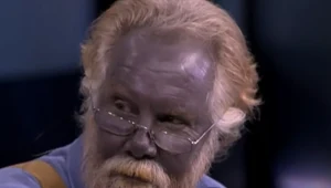 Na zdj. Paul Karason, chory na srebrzycę z powodu przyjmowania dużej ilości srebra koloidalnego