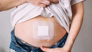 Problem przepukliny dotyczyć może nawet 20 proc. populacji