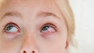 Zespół Kawasaki - ostra choroba układowa. Bywa mylona z odrą