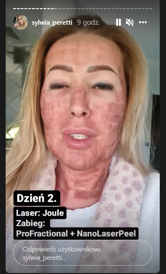 Sylwia Peretti pokazała zdjęcia po zabiegu laserowym/ źródło: https://www.instagram.com/sylwia_peretti/?hl=pl