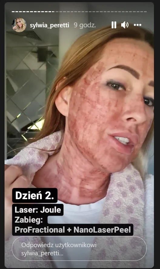 Sylwia Peretti pokazała zdjęcia po zabiegu laserowym/ źródło: https://www.instagram.com/sylwia_peretti/?hl=p