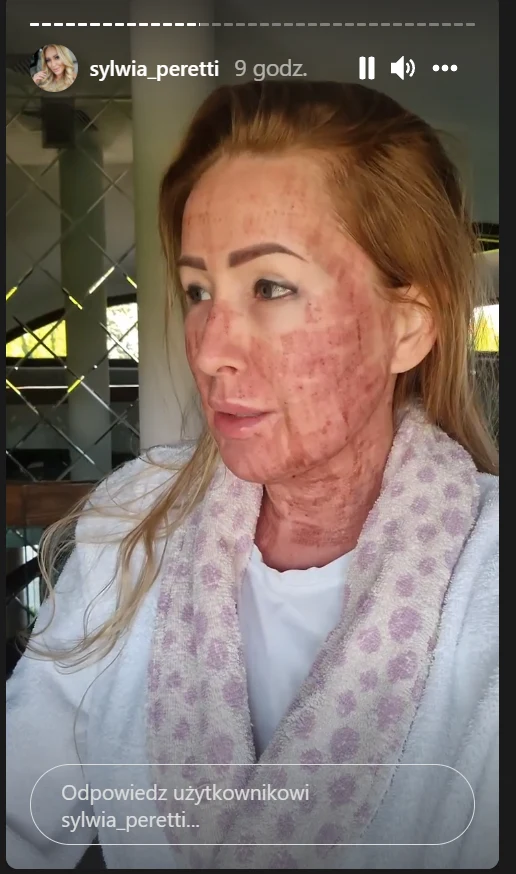 Sylwia Peretti pokazała zdjęcia po zabiegu laserowym/ źródło: https://www.instagram.com/sylwia_peretti/?hl=p