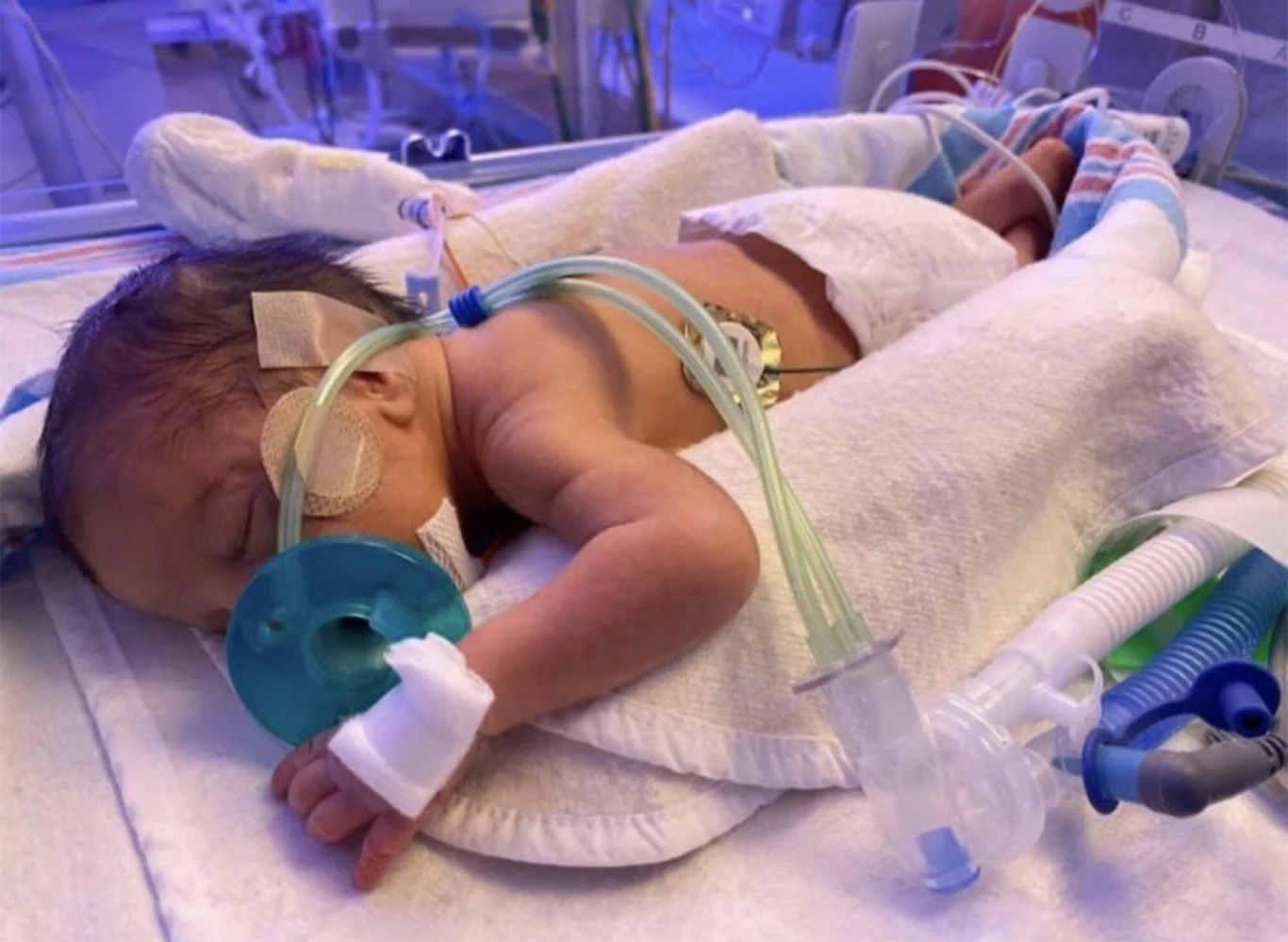 Wirus RS jest szczególnie niebezpieczny dla wcześniaków Wirus RS jest szczególnie niebezpieczny dla wcześniaków