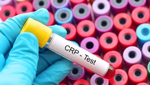Najwyższe wartości CRP oznacza się w przypadku ostrego zapalenia trzustki powikłanego martwicą, rozległych oparzeń, martwicy tkanek i w uszkodzeniach wielonarządowych