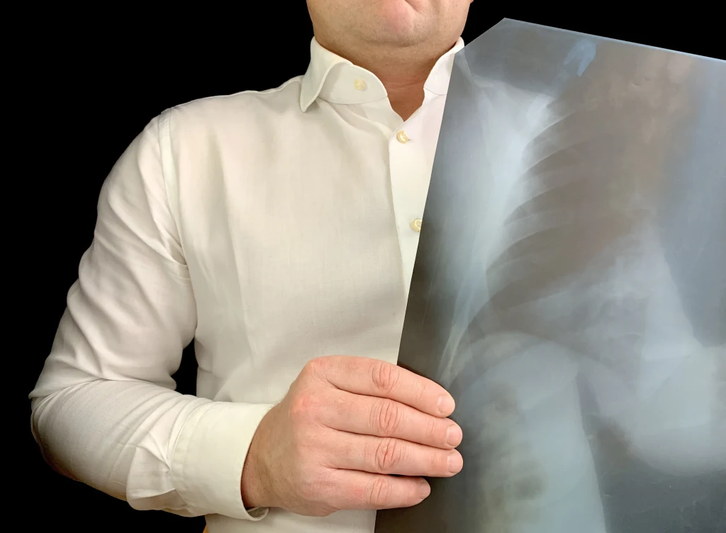 Rocznie w Polsce diagnozuje się ok. 150-200 przypadków raka piersi u mężczyzn Rocznie w Polsce diagnozuje się ok. 150-200 przypadków raka piersi u mężczyzn