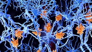 Stwardnienie rozsiane to choroba nieuleczalna - leczenie nie jest w stanie odwrócić uszkodzeń, które już się pojawiły