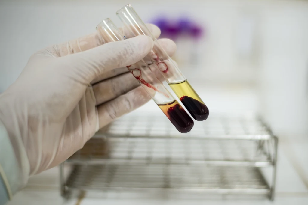 Do konfliktu serologicznego dochodzi, gdy ciężarna ma grupę krwi Rh-, a ojciec dziecka Rh+