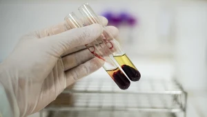 Do konfliktu serologicznego dochodzi, gdy ciężarna ma grupę krwi Rh-, a ojciec dziecka Rh+