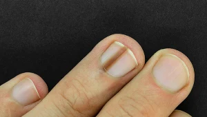 Czerniak paznokcia jest trudny do zidentyfikowania. Można go pomylić ze zwyczajnym urazem