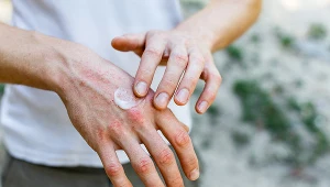 Też masz takie dłonie? Winne żele antybakteryjne, pierwsze chłody lub choroba