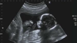 ​Zespół Edwardsa. Trisomia 18 pary chromosomów, co oznacza dla dziecka i matki?