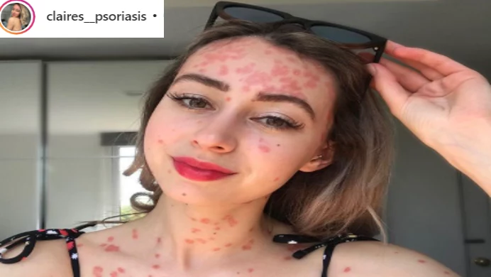 Instagramerka cierpi na ciężką postać łuszczycy, ale nauczyła się akceptować swoje ciało 