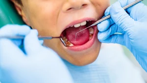 Koniec z borowaniem? Opracowali żel, który naprawia zęby