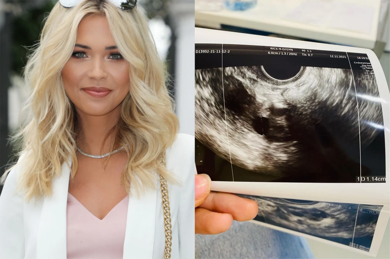 Sandra Kubicka zdjęcie USG Sandra Kubicka zdjęcie USG