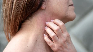 Nie bagatelizuj wysypki. To objaw wielu różnych chorób