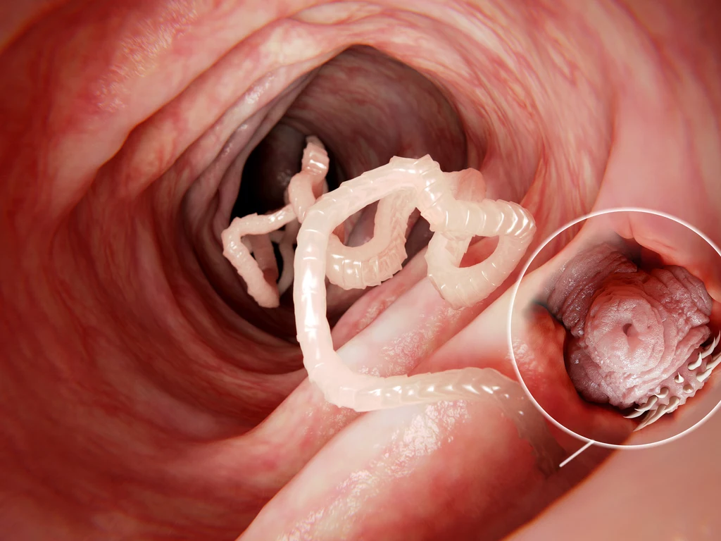 Lekarze z Massachusetts General Hospital postawili diagnozę - cysticerkozę (wągrzycę), czyli zarażenie tasiemcem.