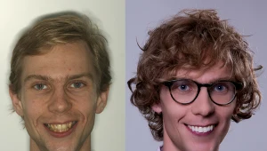 Wybielone i wyprostowane zęby znacznie poprawiły wygląd młodego prawnika z Warszawy